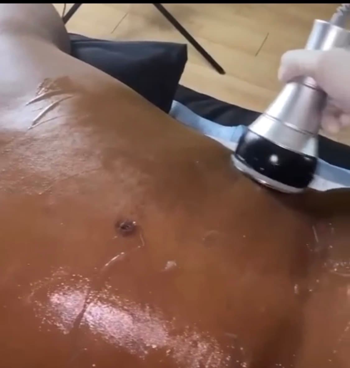 Handheld ultrasonic cavitation device being used on a person's abdomen covered in conductive gel.